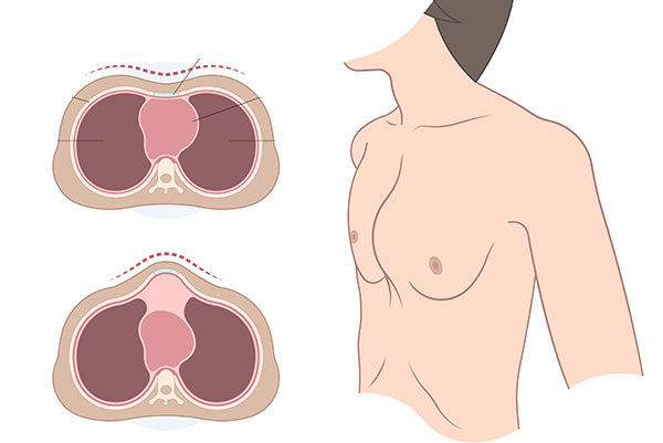pectus_carinatum
