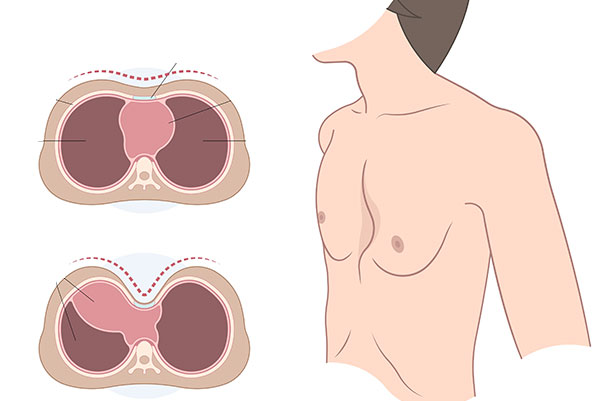 pectus_excavatum